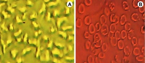<strong>A,</strong> Optical micrographic of untreated SS blood; <strong>B,</strong> red blood cells treated with petroleum extract of <em>Terminalia</em><em>ivorensis</em> (50 Âµg.mL<sup>-1</sup>).